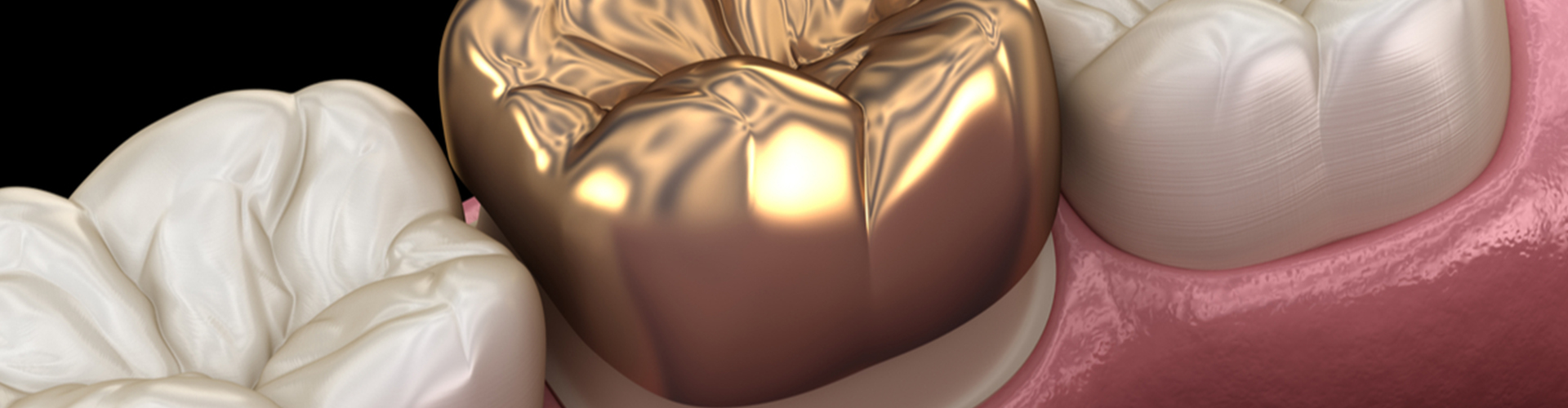 rendering of a gold dental crown